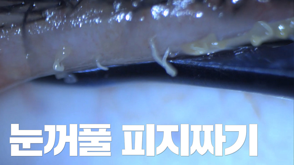 안과 눈꺼풀 피지 압출  막힌 기름샘 짜기  마이봄샘